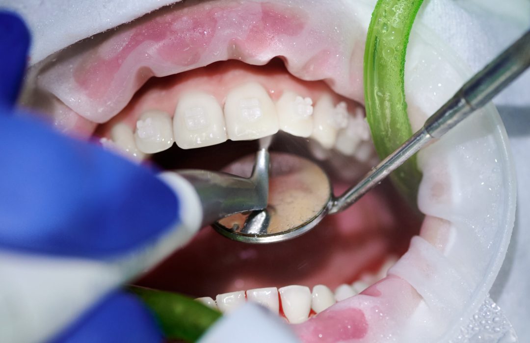 Macro photography. Top view on cleaning process in patient's mouth with cheek retractor and brackets on teeth. Cleansing teeth with water jet and saliva ejector. Concept of professional dental hygiene